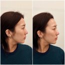 통증 없는 즉각적인 얼굴선 리프팅 효과 좋은 에어젯 리프팅 제이라인코리아 솔직 후기