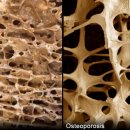﻿뼈 (골다공증세)＜혐오사진＞ 이미지