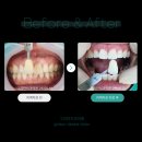 백치과의원 | [수원미백치과] 치아 미백, 여름철 휴가 자신 있게 사진 찍자! (실제 후기)