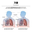 삼성산소(주) | [공지] 기흉수술 흉강경 폐쐐기절제술 후기｜참다가 응급으로 간 이야기