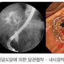 담관 담도암 생존율 초기증상 원인 진단 완치 치료 이미지