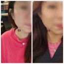 밴스의원 화곡 턱보톡스 맞아본 후기
