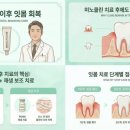 이지이비인후과의원 | 미노클린 이후, 잇몸은 어떻게 회복되어야 할까요? (미노클린 치료했는데 잇몸이 아직 불편한 이유)