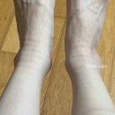 발목 접지름, 인대 늘어나서 2주 고생한 후기(발목염좌 엑스레이, 약침치료, 물리치료, 정형외과?한의원...