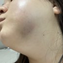 혹부리한의원 | 왼쪽 매복사랑니 위아래 발치 2~4일차. 붓기&amp;통증 경과 후기(신촌세브란스 발치)