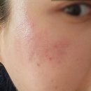여드름흉터치료 선릉역피부과 맑은선의원 피코프락셀 효과 통증 후기