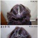 동명미장원 | 아내의 탈모 - 인천 60대 여성 정수리 탈모고민 성공 후기