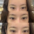 코디성형외과의원 | 팝성형외과 쌍꺼풀 눈 재수술 1일차 따끈한 후기