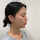 홍대 코필러 코실리프팅 : 폼미코 시술 한달 반 후기