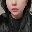 북부역전 | 인천 부평 피부과 입술필러 만족 후기!