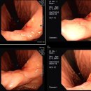 위암 내시경사진입니다..도움말부탁드려요.. 이미지