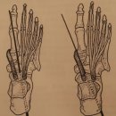 forefoot varus deformity에서의 tibialis anterior m 의 비기능적 패턴 이미지