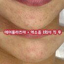 [부산/시청역]연제구 연산동 서연뷰티 에스테틱 화이트힐 에어플라즈마 관리받고 대만족한 후기
