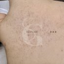 일산 모공각화증 전문 에스테틱샵 썸굿의 웨딩케어 후기