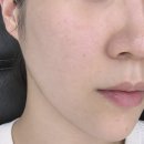 쥬 | 압구정피부과 청담피부과 포텐자 쥬베룩 포텐쥬 모공시술 추천 후기