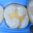 김창우치과의원 | [공지] [가산 치과] 대학병원에서도 소문난 사랑니 발치왕