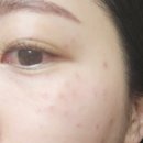 디샤인의원 | [피코토닝]송파나루역 피부과 디샤인의원 레이저 후기