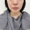 현한의원 | 서면다이어트한의원 온다리프팅 2회차 방문 후기