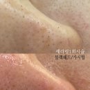 무아 플레이스 강남 피부관리 스킨플래닝 플라즈마