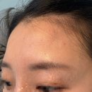 루가의원 | 판교보톡스 점심시간 보톡스 후기 (미간 이마 턱) 유지기간