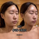 라인핏 | 대구 봉덕동 피부관리 라니스킨케어 페이스라인핏 후기