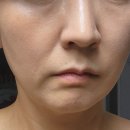 강남구청역피부과 울쎄라피프라임 멍, 붓기, 가격, 전후비교 솔직 후기