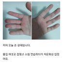 스팀 연습 하다가 저온 화상 입었습니다. 이미지