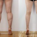 유나메디칼 | [세이지의원 리포트] 종아리주사 효과의 정밀 진단과 부작용 없는 하체 성형을 위한 빅데이터 가이드