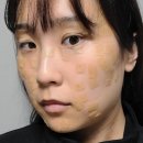 천호화이트피부과에서 얼굴목편평사마귀 어붐야그레이저로 제거 완료 후기! 비용 합리적인 병원