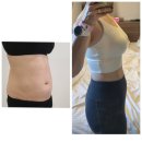 안나메디칼 | 복부 지방분해주사 효과 부작용 가격 솔직 후기 (유스키니 2회차)