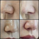 진공 피지제거기 솔직후기 셀웨이브 피지제거기 피지흡입기