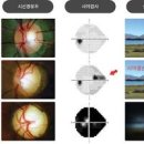 녹내장 증상 ＜30대 녹내장 원인, 진단＞ 시력을 잃은 질환 &#39;녹내장에 좋은 음식&#39; 이미지