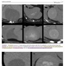 GB mucocele을 감별하는 데 있어, CT attenuation value와 mineral distribution 이미지