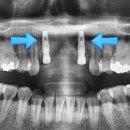 (주)투디임플란트 | 앞니 임플란트(브릿지)와 부분교정 진단의 중요성 및 후기