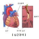 오래된 심근경색증 이미지