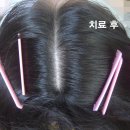 탈모치료용 봉독을 생산하는 약성 좋은 숲속 양봉장의 봉독으로 탈모치료 하는 사람들~~ 이미지