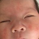 후기>제로이드 MD 인텐시브 크림 아토피 의심! 다 나았어요