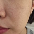 디오레 | 원주 원더스의원 아기레이저(디오레) 후기