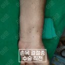 분당서울정형외과 네이버블로그