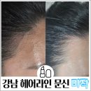 강남 선릉역 헤어라인 문신 미작뷰티 강남본점 일주일 뒤 후기