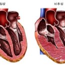 비후성 심근증[hypertrophic cardiomyopathy, HCMP] 이미지