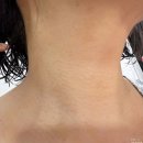 누가한의원 | 순천 쥐젖제거 부산 화접몽한의원 내돈내산 리얼후기 비포에프터사진 有