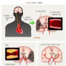 [간편]뇌졸중 진단비(1년50%) 특별약관 이미지