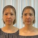 경전철 회룡역 | 의정부 호원동 회룡역 피부관리 가꾸는동안 &amp; 숲칼프 윤곽관리 후기