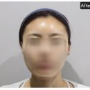 본피부과의원 | 벤자민피부과의원 명동점 올타이트 내돈내산 후기