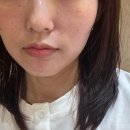 리즈동물병원 | 청담피부과추천 버츄RF 울트라콜100 베네핏 스킨보톡스 한번에 맞은 후기 마취X 효과 통증
