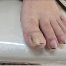 세종발톱무좀 문제성발톱 관리 후 시큰거림까지 없어졌어요 발데렐라