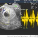 임신6주 초음파사진 이미지
