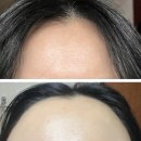 강남-107 | 강남성형외과 스킨보톡스 이마 주름 후기 I 겨울철 잔주름 속광 채우기, 강남 스킨보톡스 맛집 추천