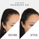 충장로-3 | 충장로남자가발 3개월 후기 절대 하지 마세요